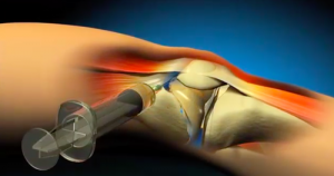 infiltrações artrose joelho